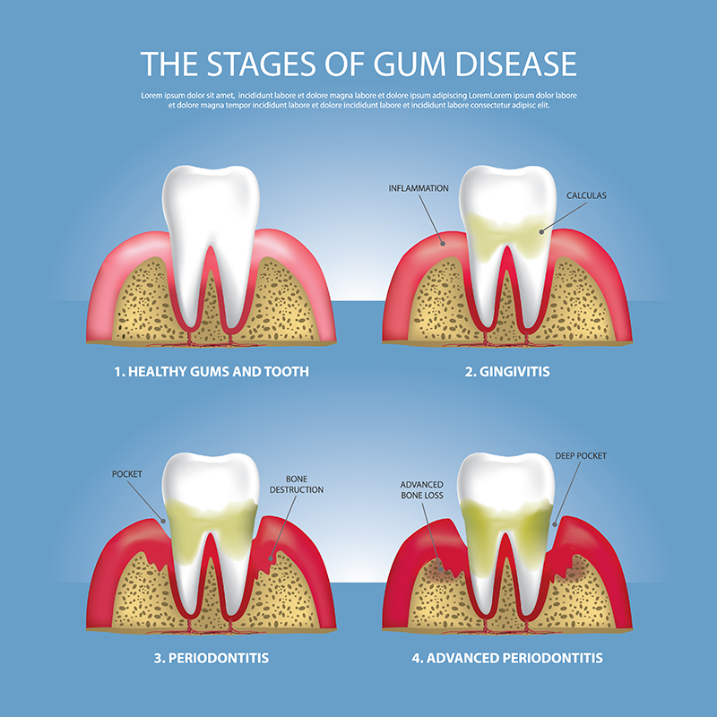 Gum Disease Treatment | Harry Albers, DDS | Santa Rosa